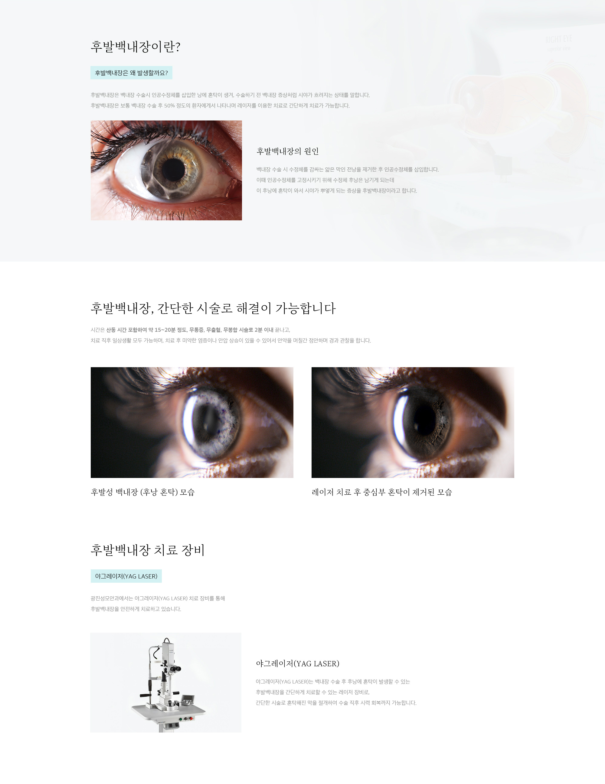 후발백내장
