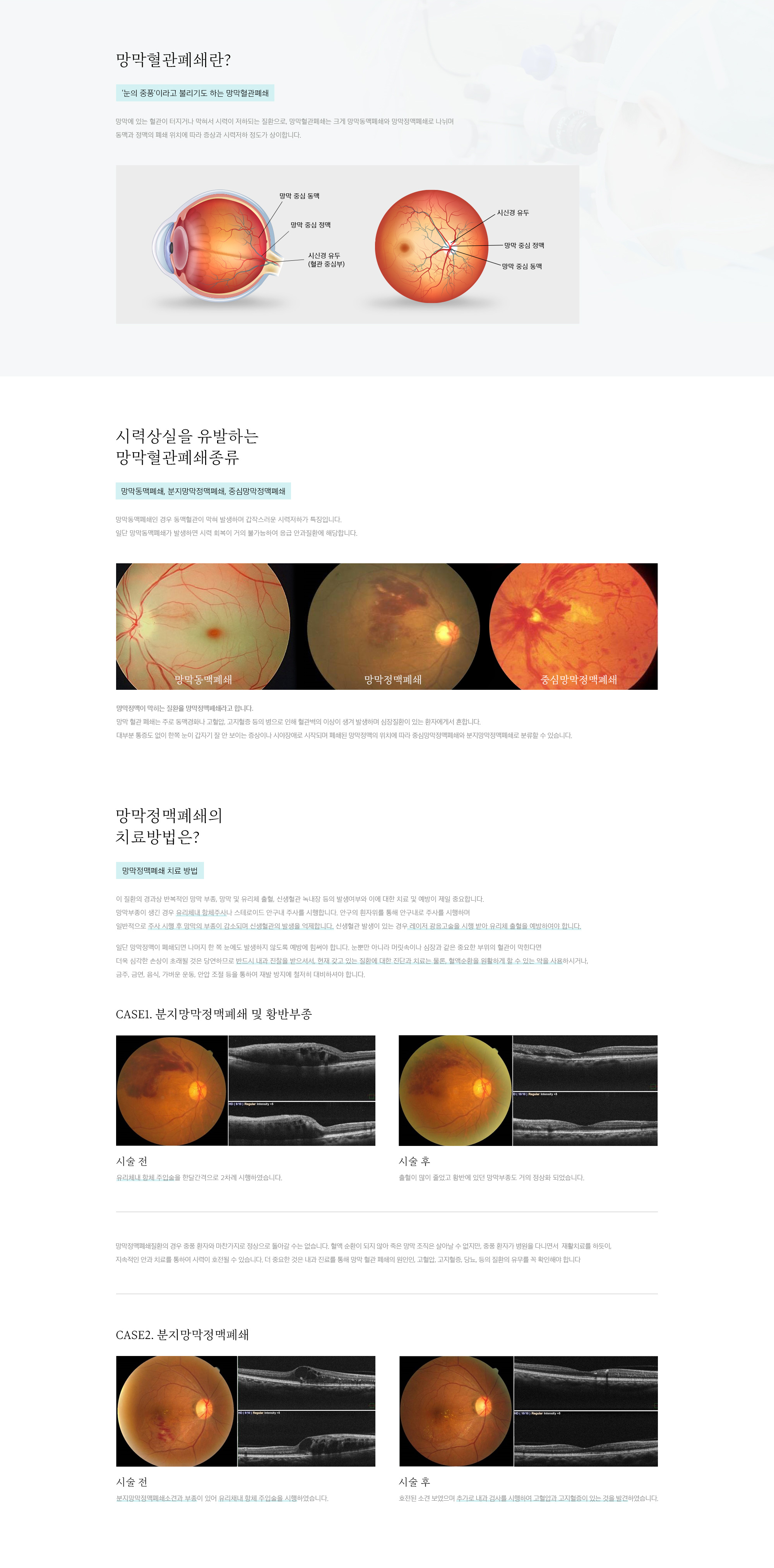 망막혈관폐쇄