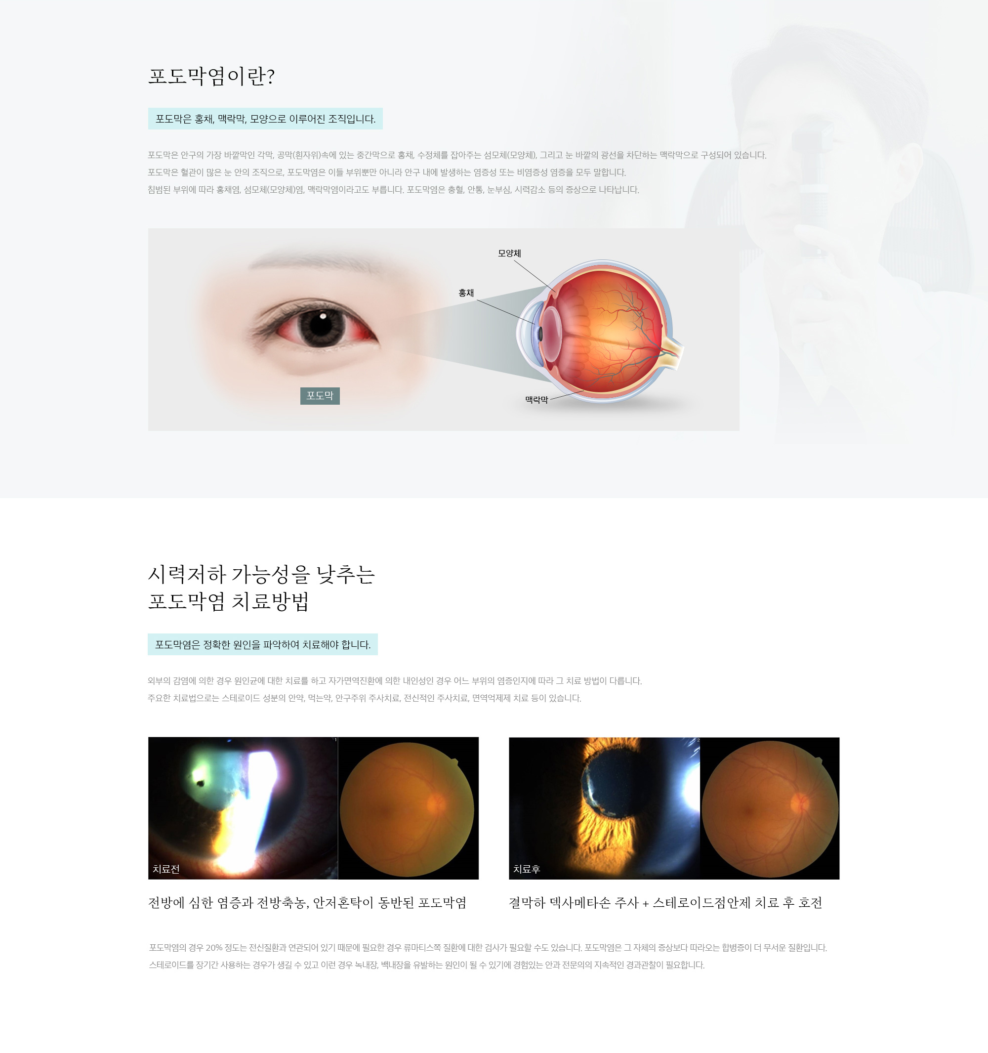 포도막염