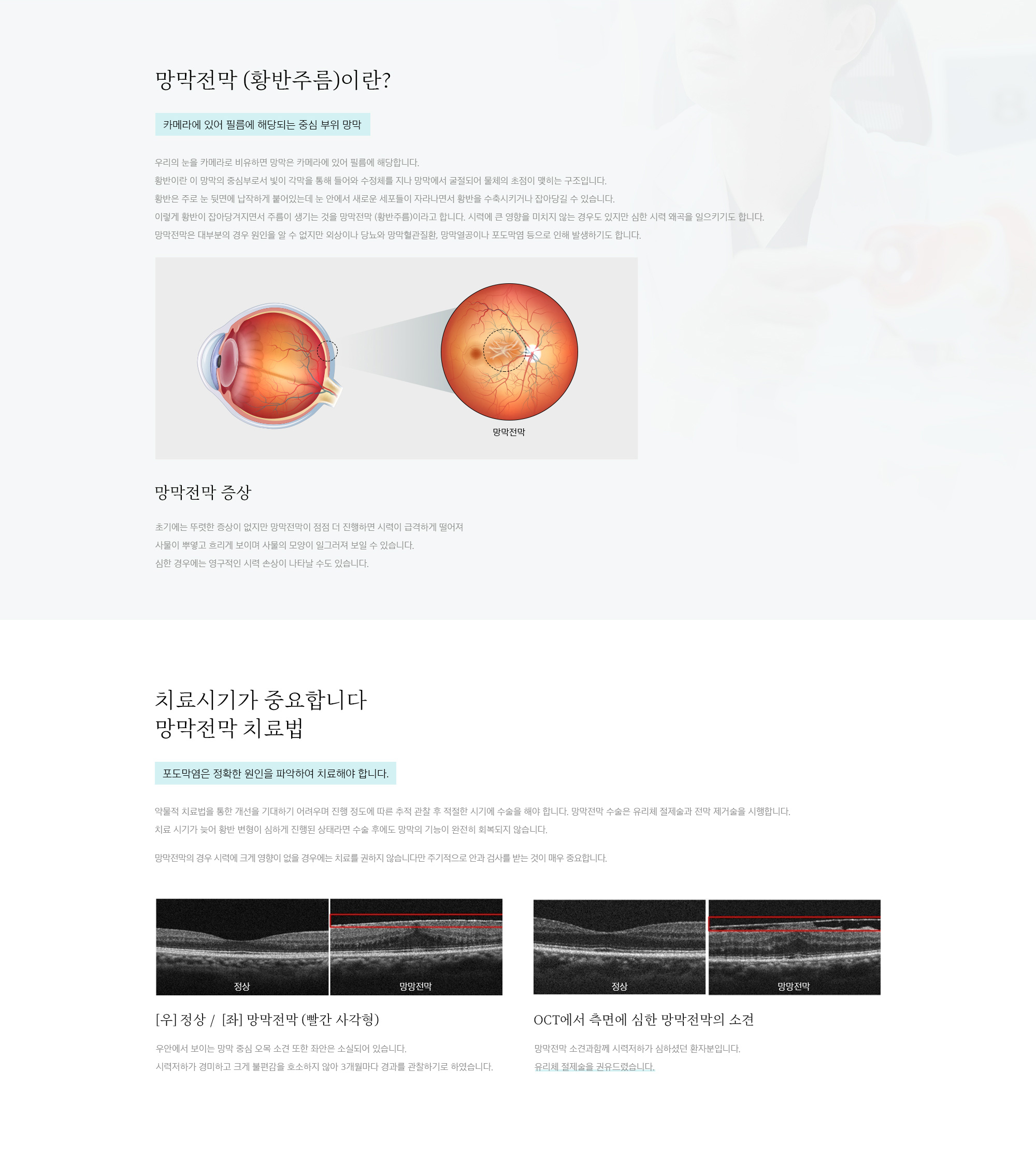 망막전막
